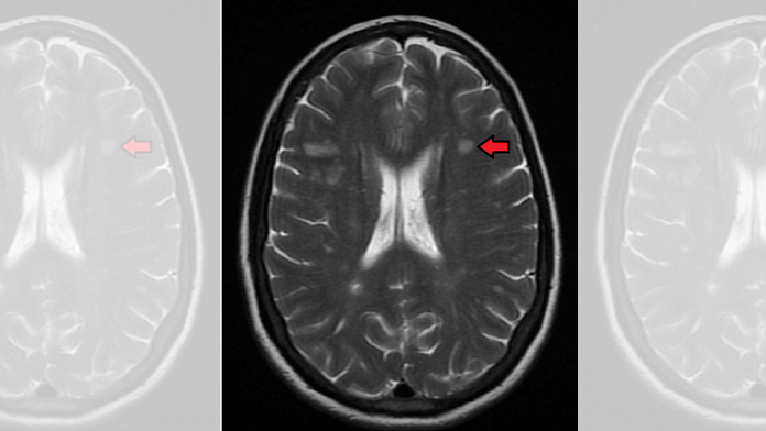 Multiple sclerosis as seen on MRI | Commons/ James Heilman, MD