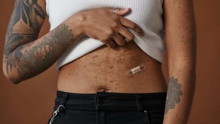 Don’t let back and body acne frustrate you. Follow these steps to prevent & control symptoms