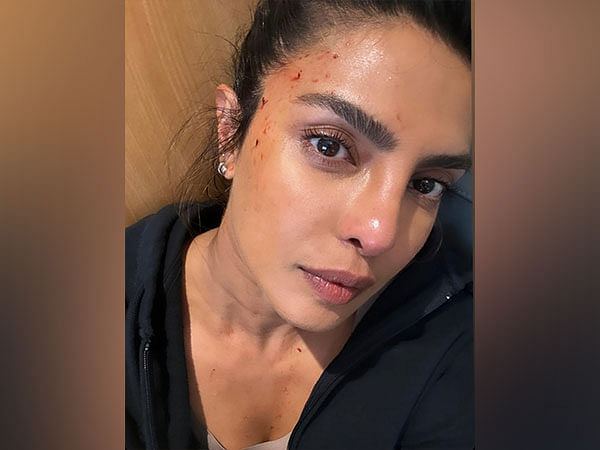 Priyanka Chopra shares photo of bloodied forehead from 'Heads of State' set 