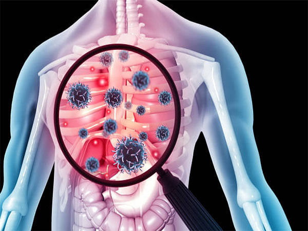 Absence of full drug-susceptibility data for TB patients can result in amplifying resistance, compromise treatment outcomes: HaystackAnalytics report