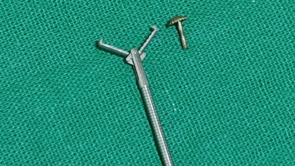 A team of doctors in Kolkata successfully removed gold nose pin screw from a woman’s right lung | Photo: Special arrangement