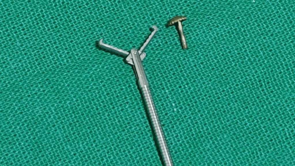 Kolkata doctors retrieve nose pin screw lodged in woman’s lung with non ...