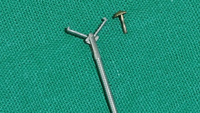 A team of doctors in Kolkata successfully removed gold nose pin screw from a woman’s right lung | Photo: Special arrangement
