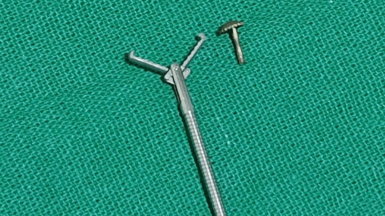 Kolkata doctors retrieve nose pin screw lodged in woman’s lung with non-invasive surgery
