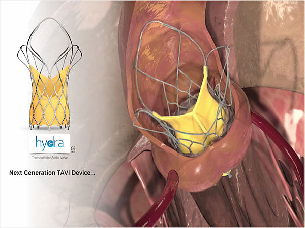 SMT Won the Italian National CONSIP 2-Year Tender to Supply Hydra TAVI in All Italian Hospitals