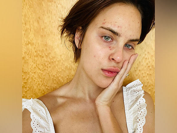 Tallulah Willis opens up about her struggles with skin-picking disorder