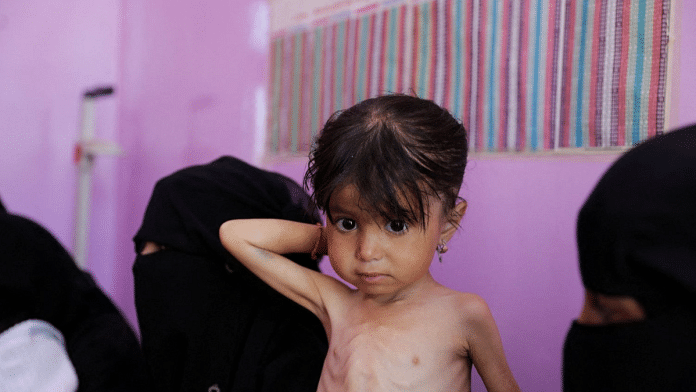 A malnourished girl waits at a measurement room of a hospital as Yemeni children face the risk of medical complications amid high levels of food insecurity, in Sanaa, Yemen 2 March, 2024 | Reuters/Khaled Abdullah/File Photo