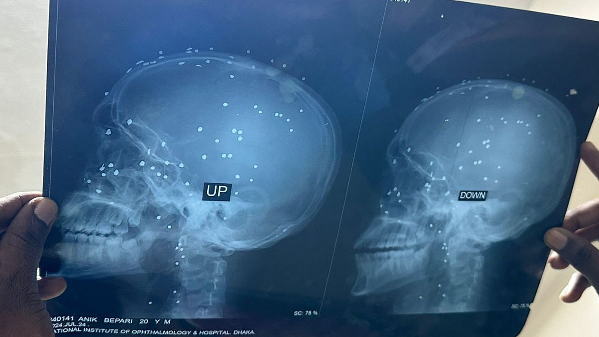 X-ray of a person admitted to the hospital | Ananya Bhardwaj | ThePrint