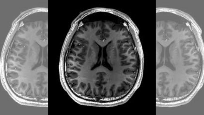 Representational image of a brain scan | Commons