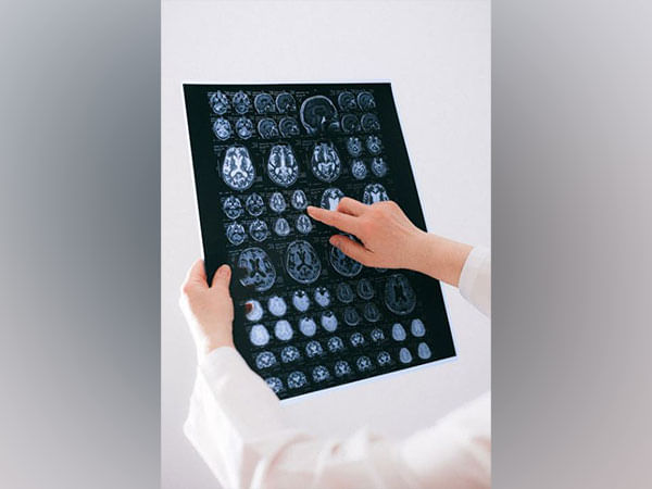 Brain map clarifies neuronal connectivity behind motor function: Study 