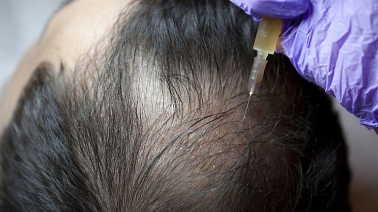 PRP Therapy is changing the hair game. It’s the ultimate antidote to thinning and baldness