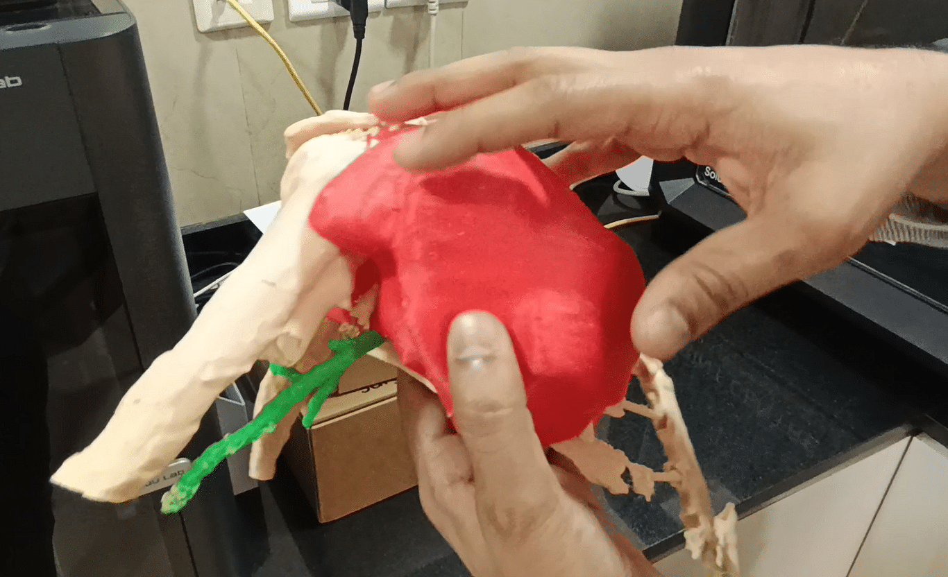 3D printed model of a chest wall (tumour in red) at Sparsh Hospital, Bengaluru | Photo: Ananthapathmanabhan, ThePrint