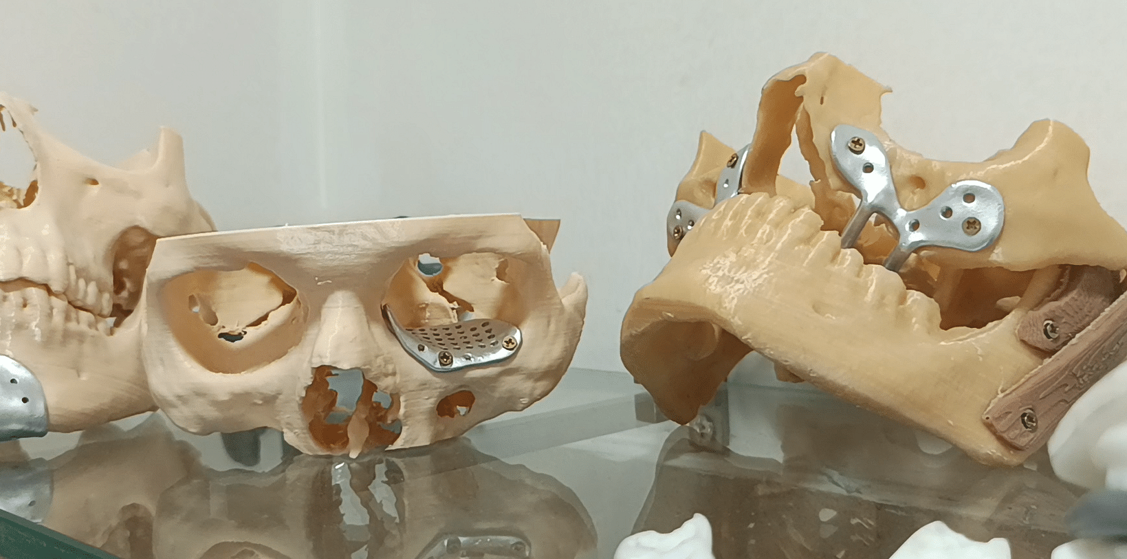 3D printed models of jaw and implants from flesh-friendly materials, at Sparsh Hospital Bengaluru | Photo: Ananthapathmanabhan, ThePrint