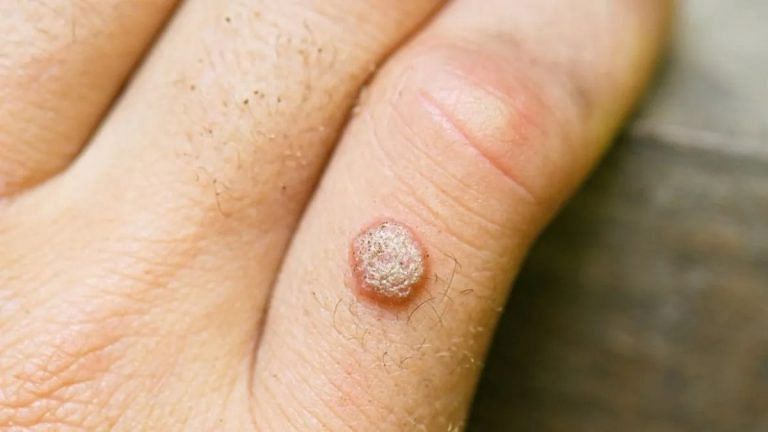 Wart hacks sound fun until you burn your skin—stick to science, not your cousin’s nuskha