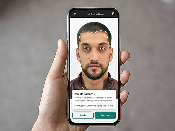 Cureskin to Launch World's First AI-Powered Hair Analyser to Combat Baldness on 20th April 2025