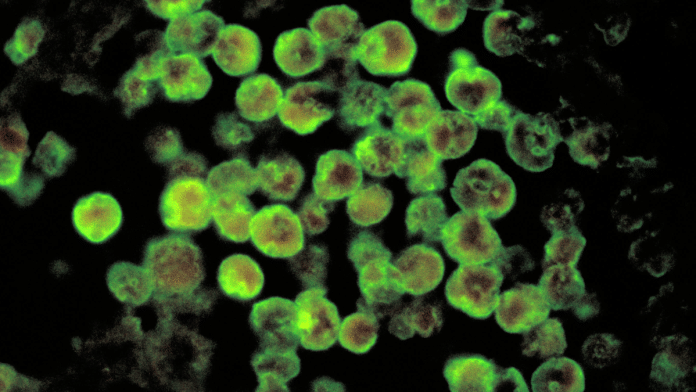 Histopathology of amebic meningoencephalitis due to Naegleria fowleri | Commons/CDC